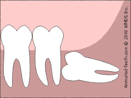 How much time you need off work for recovery. Estimating Wisdom Tooth Extraction Difficulty Erupted Impacted Teeth
