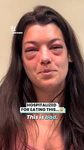 Allergic Reaction Ruined My Face