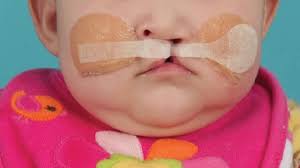 Image result for Cleft Lip
