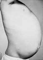10 Nursing Diagnosis For Hirschsprung S Disease Nanda Nursing Diagnosis