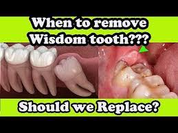 This won't cure the wisdom tooth completely, but it will help supplement your body's immune system. Wisdom Teeth Pain Teeth Pain Relief Teeth Pain Solution Dental Tourism India Youtube