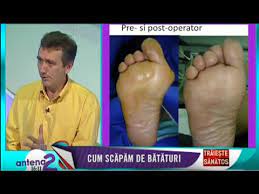 Nu mai suporti incaltamintea, din cauza unor bataturi care te supara de ceva vreme. Bataturi Si Monturi Marius Uscatu Institutul Piciorului Youtube