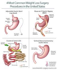 4 Ways To Reduce Your Bariatric Surgery Cost Bariatric Surgery Source Bariatric Surgery Diet Pre Bariatric Surgery Diet Bariatric