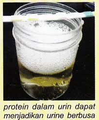 Namun saat kencingmu berwarna gelap dan berbau, maka bisa jadi ada masalah dengan kesehatanmu. Selesaikan Masalah Berkaitan Buah Pinggang Hati Dengan Produk By Drazlan Air Kencing Berbuih Ke Tahukah Mengapa Munculnya Buih Tersebut Di Dalam Air Kencing Jika Menganggap Ianya Adalah Perkara