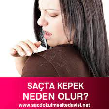 Sacta Kepek Neden Olur