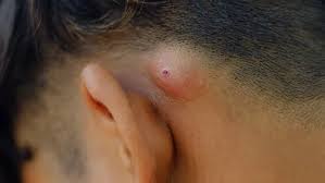 Image result for Skin Infection