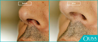 Make sure you follow all. How To Remove Hair On Nose Laser Treatment For Nasal Hair