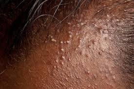 Symptoms of sjs include fever. Hiv And Aids Rashes And Skin Conditions