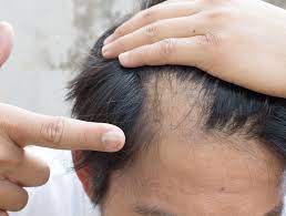 Try a vitamin blend containing 3 mg of biotin, 30 mg of zinc, 200 mg of vitamin c, and less than 1 mg of folic acid to see if this helps. The 5 Suprising Remedies That Stop Hair Loss Naturally