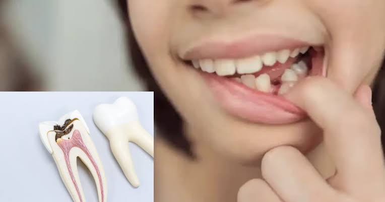 Saving Baby Teeth: Vital Pulp Therapy For Kids | Essential Endodontics