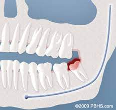 Wisdom teeth get pulled out to prevent pain and discomfort. Wisdom Tooth Removal Ut Dentistry