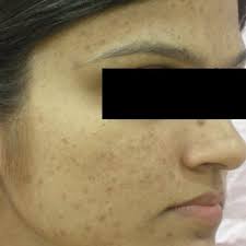 The concentration of glycolic acid. Pdf Glycolic Acid Peel Therapy A Current Review