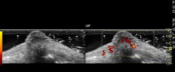 The main reason is that unless you get rid of the disease, the granulomas often grow back. Suture Granuloma Elbow Radiology Case Radiopaedia Org