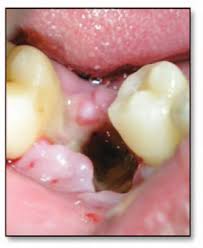 Image result for Alveolitis sicca)