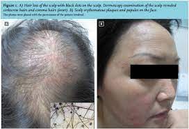 There are 81 conditions associated with dry skin, fatigue, hair loss and pale skin. Article Facial Rash And Alopecia In A Patient With Systemic Lupus Erythematosus Full Text April 2017 Njm