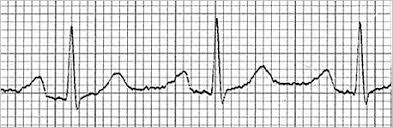 Practice quiz 2.1 is a 15 question quiz of atrial and junctional rhythms. Ecg Learning Center Test