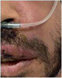 Image result for phlegmon on face)