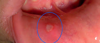 Image result for Puchýře na jazyku