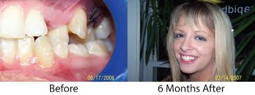 Speed Braces for Adults in Boston