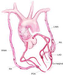 In human anatomy, the internal thoracic artery (ita), previously commonly known as the internal mammary artery (a name still common among surgeons), is an artery that supplies the anterior chest wall and the breasts. Illustration Of Bilateral Internal Mammary Artery Grafts Rima Right Download Scientific Diagram