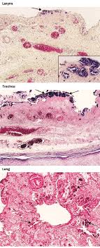 The pvl gene was detected in isolates from patients with recurrent primary skin infections and s. Survival Of Patients With Staphylococcus Aureus Pneumonia According To Download Scientific Diagram