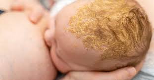 Image result for white scabs on the head in children