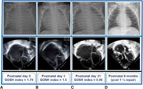 Outcomes Of Neonatal Ebstein S Anomaly Without Right Ventricular Forward Flow Sciencedirect