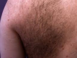 The here skin is extremely sensitive and fragile and if ingrown hair arises, you may end up with sores especially if the ingrown hair is infected. Examination Of Hair And Scalp Dermnet Nz