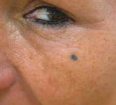 Pityriasis alba is a common skin disorder in children (90%) and young adults. Pigmentstorungen Helle Flecken Und Dunkle Knoten Pz Pharmazeutische Zeitung