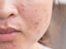 Sifat inilah yang mampu menghilangkan jerawat secara ampuh di. Petua Hilangkan Bekas Jerawat Di Muka Dengan Bahan Semulajadi