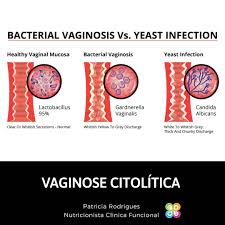 Bien, la vulvodinia es la sensación de dolor crónico que afecta a la región de la vulva. Vulvodinia Brasil Posts Facebook