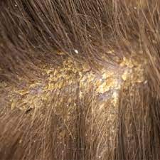 تعر ف على أنواع قشرة الشعر بالصور ويب طب