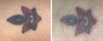 Mix 100 gm of salt in lemon juice and dip a cotton ball in this mixture. Laser Tattoo Removal London Premier Laser Clinic