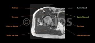 Mri patterns of neuromuscular disease involvement thigh & other muscles 2. Lower Extremity Mri Anatomical Atlas