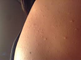 Fatty acids help in getting rid of these small bumps on arms and bumps on back arms. Tiny White Bumps On Arms Pictures Photos