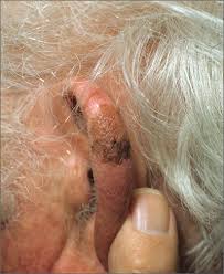 Navigating the choices for skin cancer treatment starts with understanding your options. Brown Spot On Ear Mdedge Family Medicine