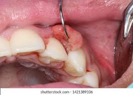 Image result for granuloma gum disease