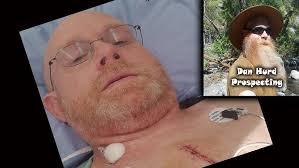 Open Heart Surgery, one week post op