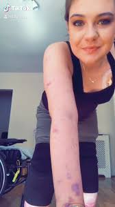 Meningitis Vaccine: Mom's Plea After Son's Death