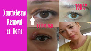 Just before jumping for unsafe treatments, methods that won't ensure results, or perhaps the enormous expense for surgery, we strongly advise you give xanthel cream a. Xanthelasma Removal At Home How I Removed Mine 3 Years Ago Fatty Eye Cholesterol Deposit Youtube