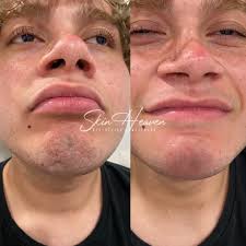 Skin Heaven ☁️✨ Rodeo Drive + OC Med Spa (@skinheavenmedspa) • Instagram  फोटोहरू र भिडियोहरू