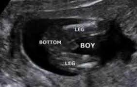 Pregnancy verification ultrasound at 6 weeks $25. Gender Scans Sexing Your Baby The Original Window To The Womb