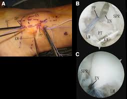 (from warren lf, marshall jl. Endoscopic Superior Peroneal Retinaculum Reconstruction Sciencedirect