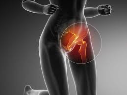 Nabelbruch ohne obstruktion oder brandwunde k42. Leistenschmerzen Behandeln Diagnose Therapie Orthozentrum Bergstrasse