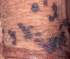 Image result for penis mycosis symptoms