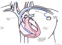 In most cases, you can lead a normal life with an icd. Defibrillator Defi Icd Alle Fragen Alle Antworten