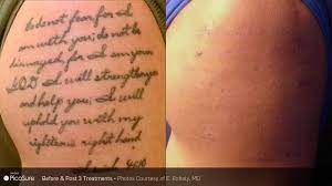 The number of sessions needed for a complete tattoo removal has decreased thanks to this invention. The Best Laser For Your Tattoo Laser Aesthetic Cetner