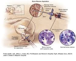 Image result for Bone Marrow Exam