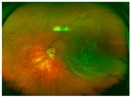 Maybe you would like to learn more about one of these? Brain Sciences Free Full Text Non Mydriatic Ultra Wide Field Imaging Versus Dilated Fundus Exam And Intraoperative Findings For Assessment Of Rhegmatogenous Retinal Detachment Html