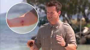 Find the perfect declan donnelly stock photos and editorial news pictures from getty images. Declan Donnelly Reveals Daughter Isla Is Behind Nasty Arm Injury As I M A Celebrity Heart